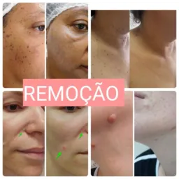 PACIENTE MODELO ESTÉTICA, PIABETÁ
